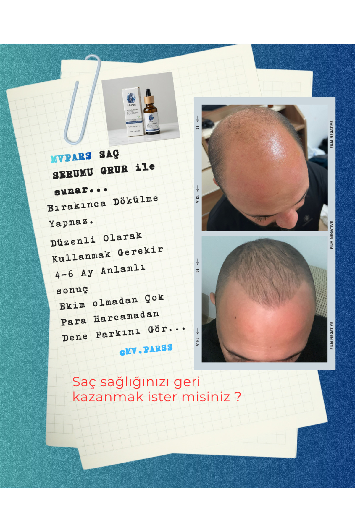 Saç Kökü Destekleyici Biyoaktif Kompleks İçeren Yoğun Bakım Serumu 5'li Paket — 5'li Serum — تصویر 4 از 6