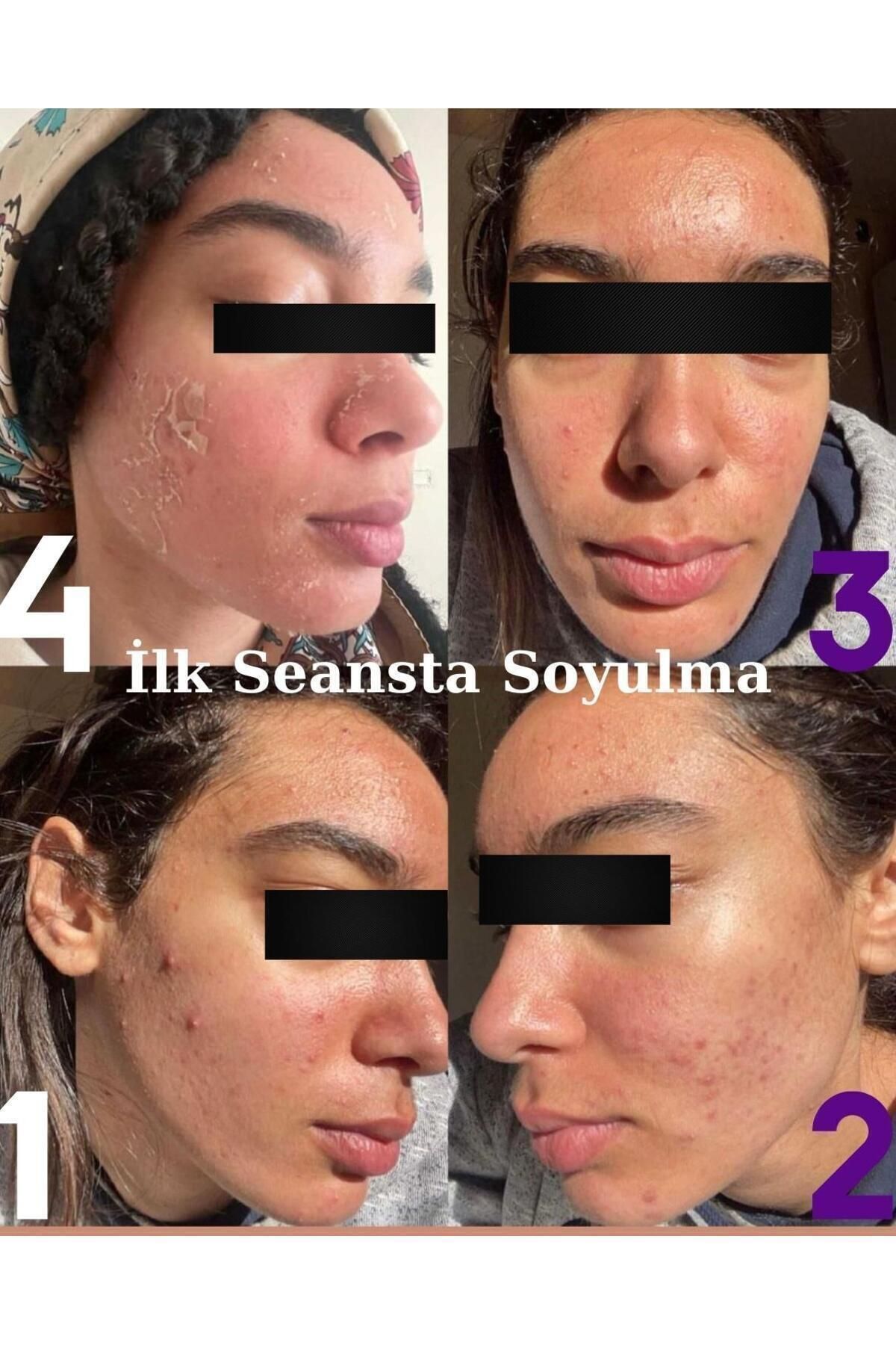 اسکراب صورت لایه بردار جلبک دریایی مراقبت از پوست ماسک جلبک دریایی لایه بردار پوست لک آکنه جوش ۵ کاربرد — ۵ عدد — تصویر 5 از 7