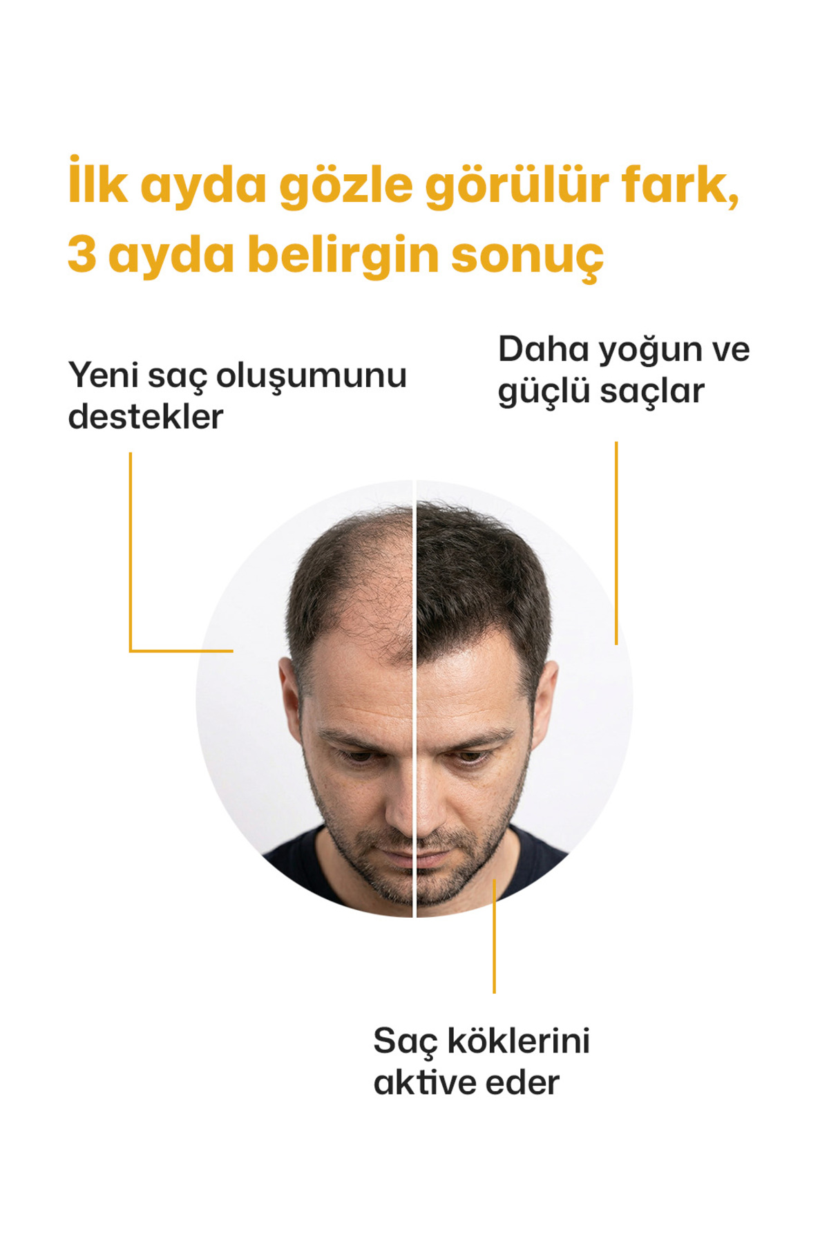 Anti-Hair Loss Saç Bakım Seti Kök Destekleyici Şampuan & Sprey — Medi001 — تصویر 4 از 8