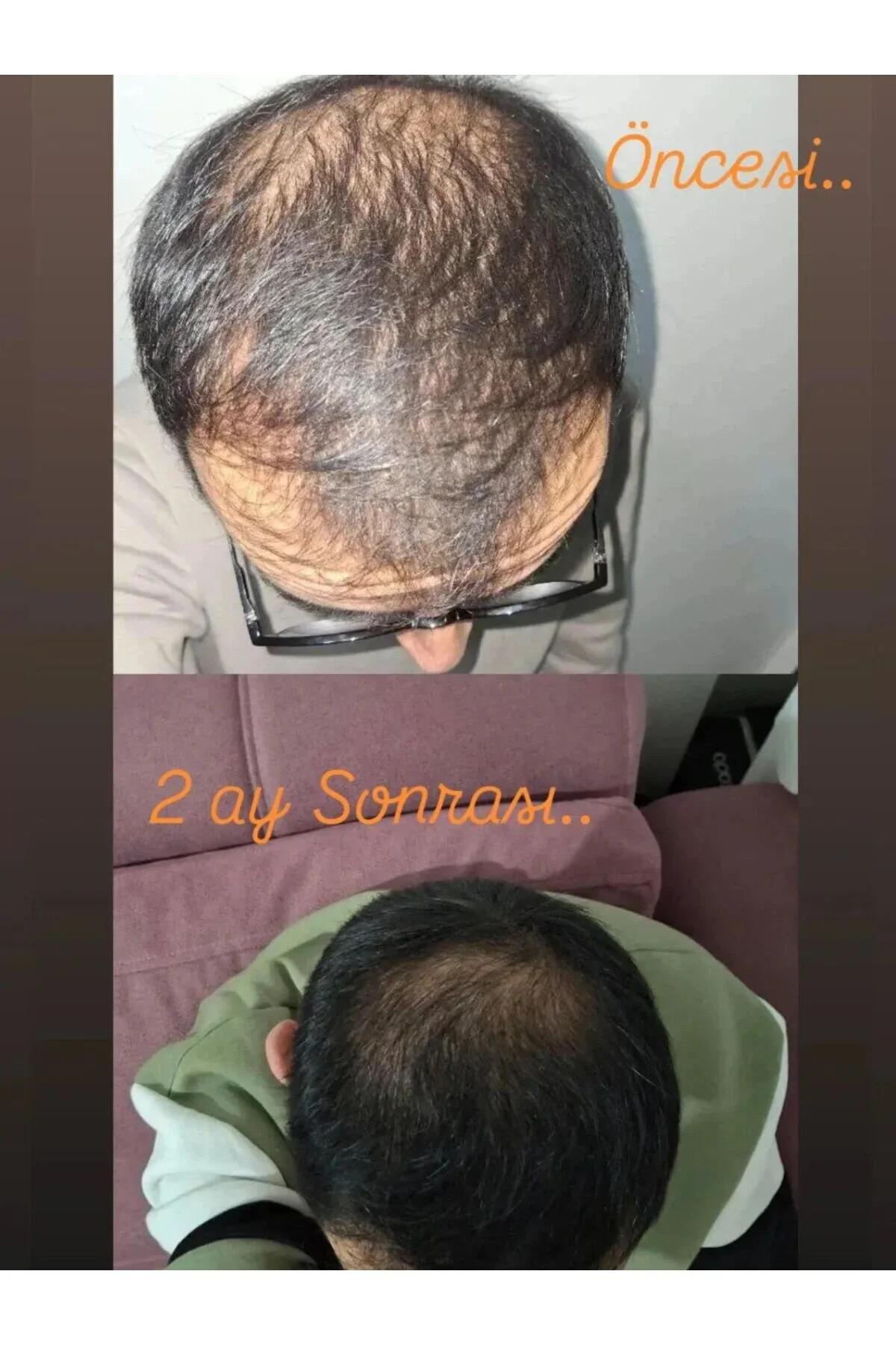 HAİRPECİA Saç Çıkarıcı ve Gürleştirici Serum - 50 mL (PRP etkili büyüme faktörleri ve Mezoterapi etkili vitamin Komplexi.) — X-GrowthPecia 50ml — تصویر 8 از 9