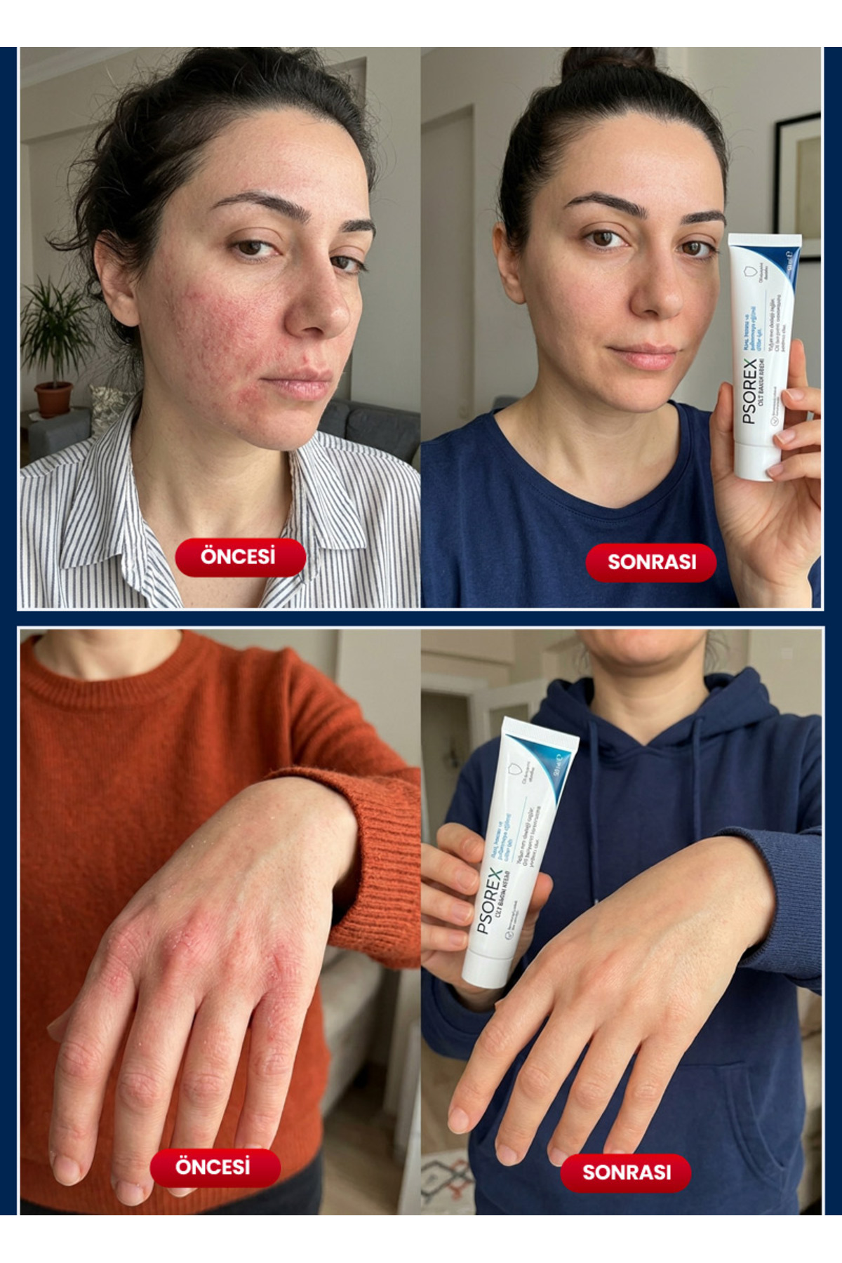 Yoğun Nemlendirici Cilt Bakım Kremi 50 ml | Egzamaya ve Sedefe Eğilimli Ciltler İçin Bariyer Destekleyici | Kuruluk ve Kızarlık için — NPP-01 — تصویر 5 از 5