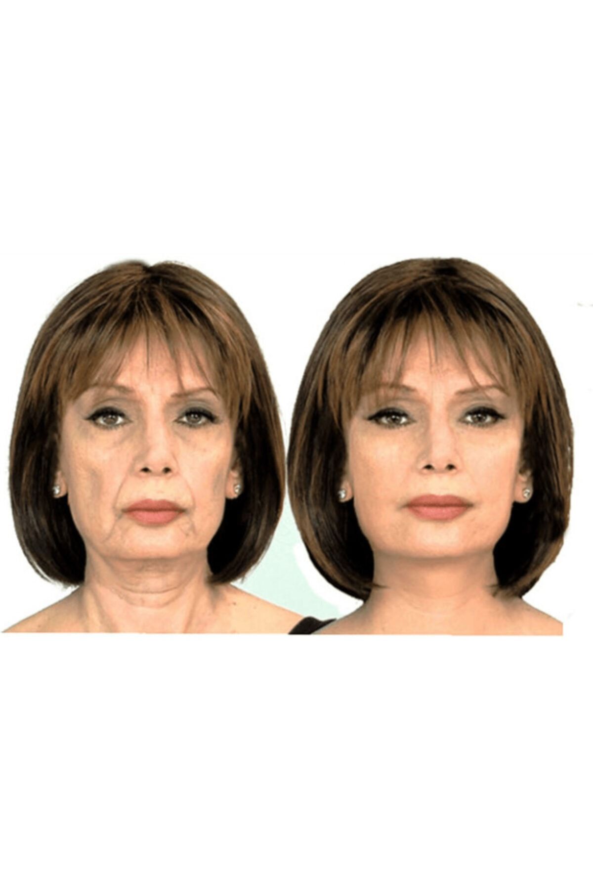 Megev-Face Lift Tape Wrinkle Prevention Tape Face Lift 5cm 5 Mt 2