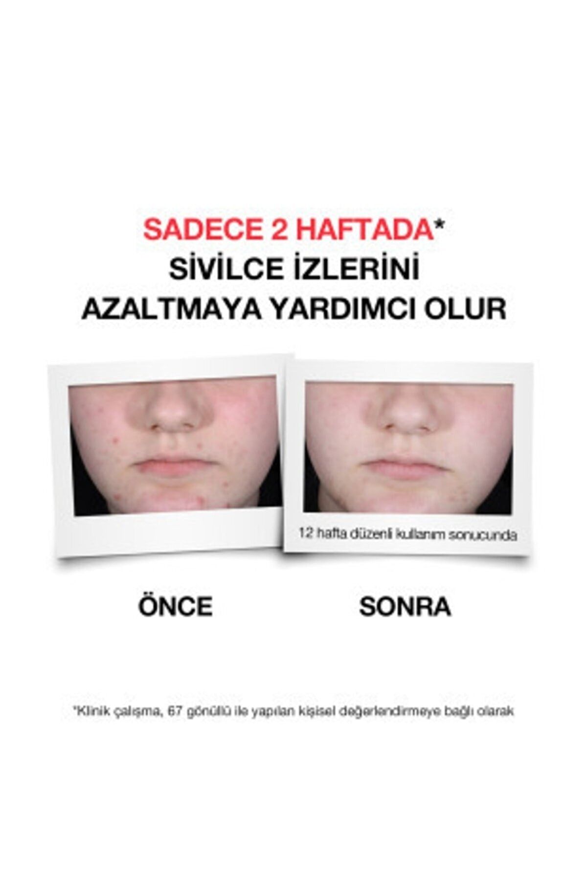 Sivilce Karşıtı Temizleme Jeli 200 Ml 2 Adet