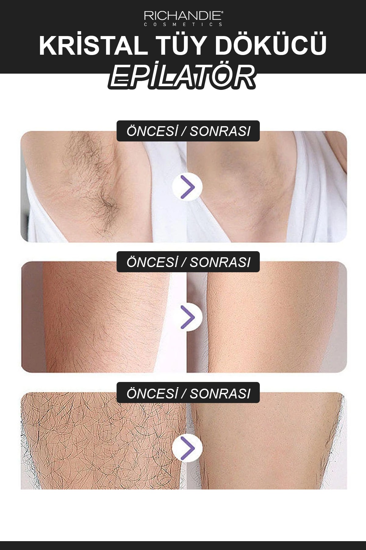 Kristal Tüy Dökücü Epilatör Siyah Crystal Eraser Epilasyon Aleti Tüy Silgisi Tüy Alıcı Fiziksel — R-TÜYDEPİ00SİYAH — تصویر 5 از 6