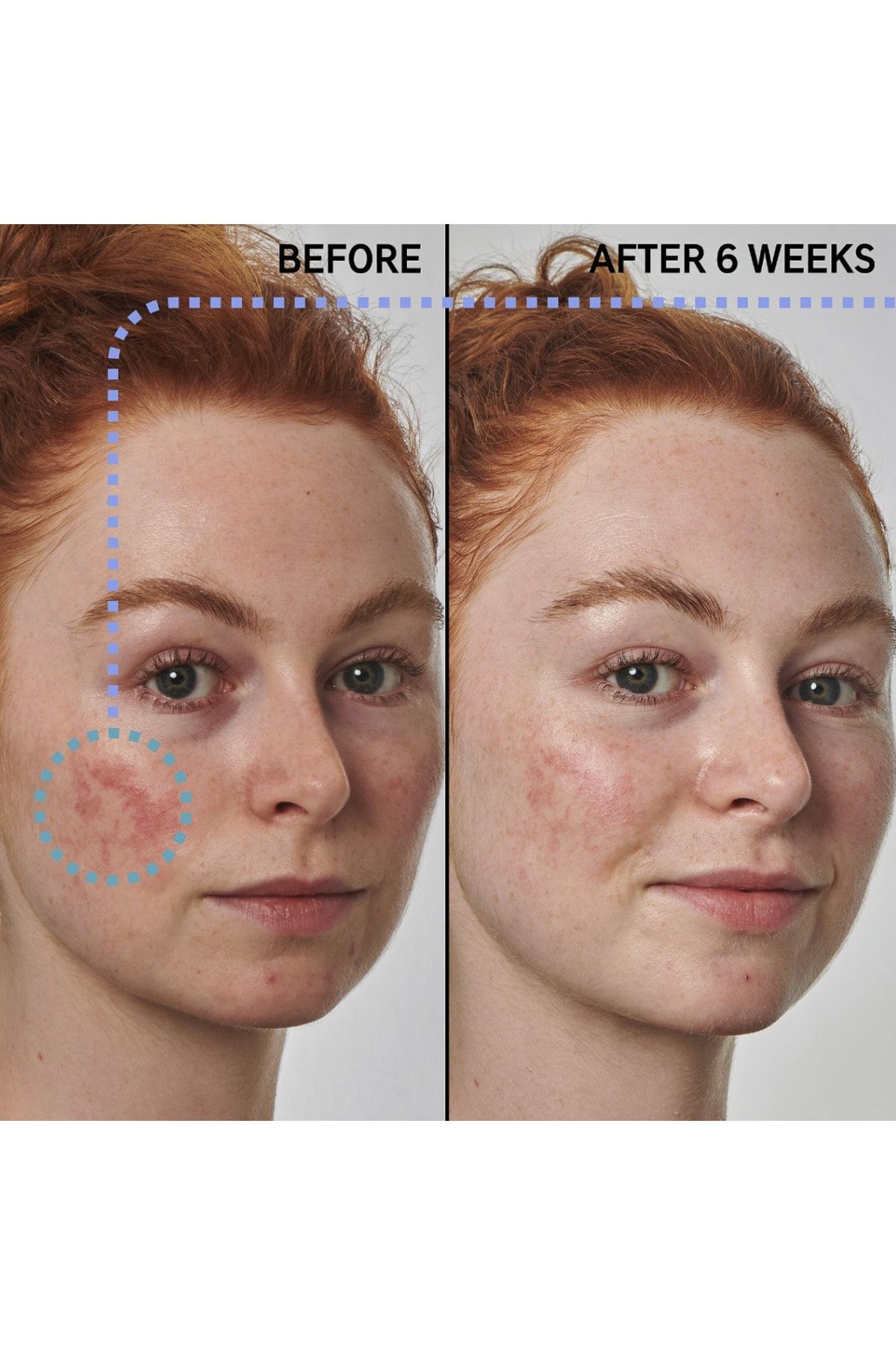 THE INKEY LIST-SuperSolutions Azelaic Serum - 10% Concentration, 30 Ml Volume, Redness Relief Formula 2