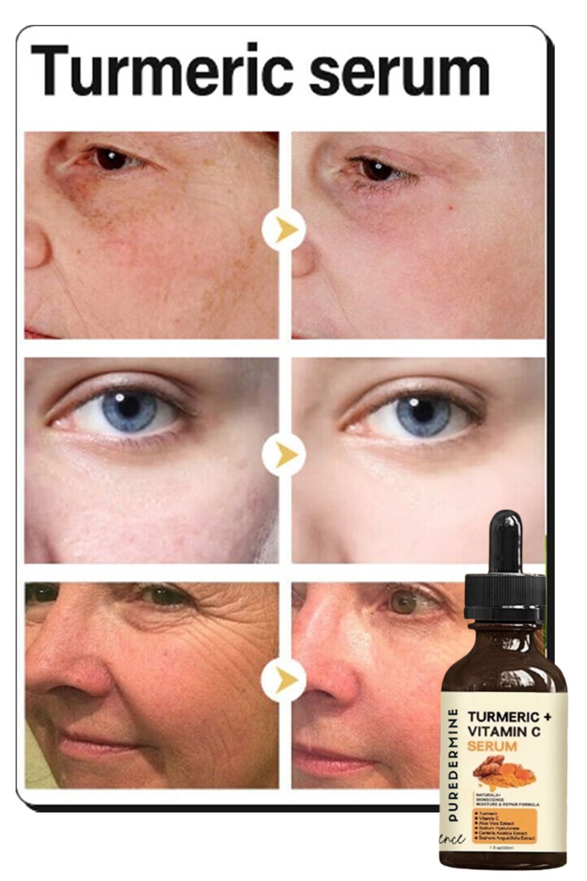 Puredermine-Strong Whitening Turmeric Serum Dark Spot & Acne & Melasma & Dark Joint & Finger Knee and Elbow 1